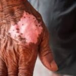 leprosy