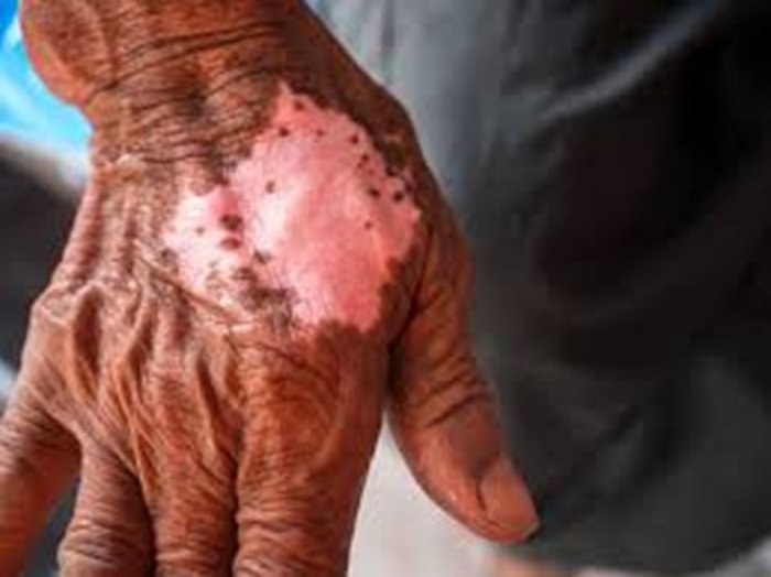 leprosy
